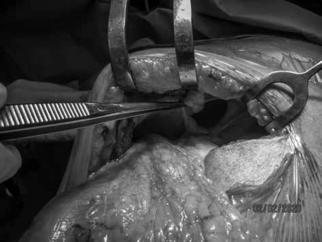 Defekt bránice po repozici colon transversum<br>
Fig. 1: Defect of the diaphragm after transverse colon reposition