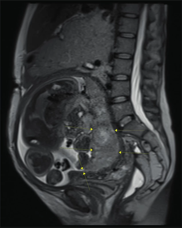 MRI dutiny břišní: placenta marginalis dosahující ze zadní
stěny k vnitřní brance [6]
