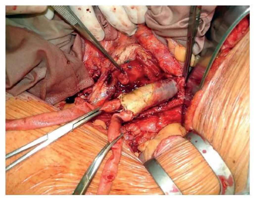 Perioperační nález aortoduodenální píštěle<br>
Fig. 1: Perioperative finding of an aortoduodenal fistula
