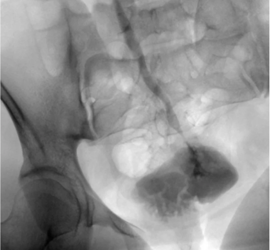 Předoperační antegrádní ureteropyelografie
(šipka označuje konkrement; inkompletní obstrukce
ureteru s odtokem kontrastní látky do rektosigmatu)<br>
Fig. 2. Preoperative antegrade ureteropyelography
(an arrow showing the stone; incomplete ureteral
obstruction with passage of contrast medium to rectosigma)
