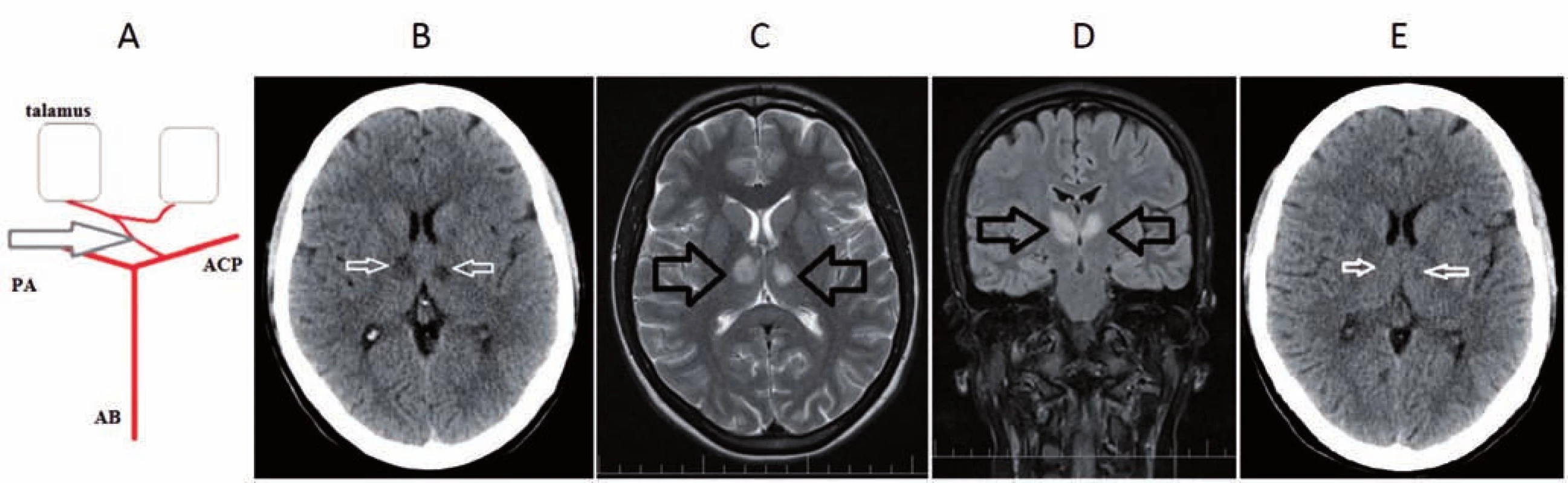 A) Percheronova artéria – anatomický variant v cievnom zásobení talamov. B) CT mozgu s nálezom hypodenzných ložísk
v talame bilaterálne, svedčiace pre čerstvú ischémiu. C, D) MR mozgu T2 sekvencie – C) transverzálne a D) koronárne rezy s nálezom
hyper intenzitných ložísk v paramediálnych častiach oboch talamov asymetrického charakteru, svedčiace pre bilaterálne akútne
ischemické lézie. E) Kontrolná CT mozgu po 7 dňoch, tzv. fogging efekt v oblasti ischémie v paramediálnych častiach talamov bilaterálne.
AB – arteria basilaris; ACP – arteria cerebri posterior; PA – Percheronova artéria<br>
Fig. 1. A) Percheron artery – an anatomical variant in the blood supply of the thalamus on both sides. B) Brain CT scan with the finding
of bilateral thalamic hypodense lesions suggesting acute ischemia. C, D) Brain MRI scan – C) transversal and D) coronal T2-weighted
with the finding of bilateral asymmetrical hyperintense lesions in paramedial area of the thalamus suggesting acute ischemia.
E) Follow-up brain CT scan after 7 days with the finding of a bilateral fogging effect in paramedial areas of the thamalus.
AB – basilar artery; ACP – posterior cerebral artery; PA – Percheron artery