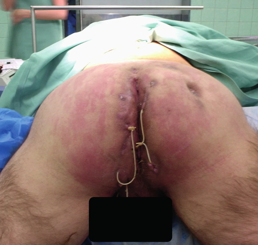 Předoperační nález<br>
Fig. 6: Preoperative finding