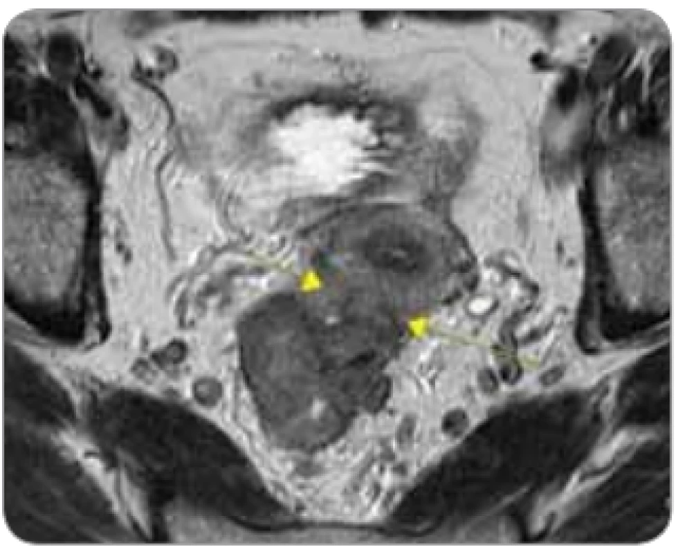 „Ugly“ tumor u pacientky s tumorózní infi ltrací stěny rekta s přerůstáním
do dělohy ventrálně, cT4b N2 M0.
