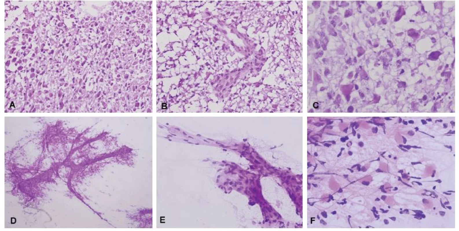 (A) Biopsia tumoru temporálne vpravo u 59-ročného muža. Radiologicky suspekný high-grade glióm. V zmrazených rezoch bol zachytený hypercelulárny
tumor tvorený atypickými bunkami s objemnou cytoplazmou. (B) Mikrovaskulárna proliferácia. (C) Detail cytologických atypií v zmrazenom reze, prítomné
boli početné mitózy. (D) V náterovej cytológii bolo možné pozorovať abnormálne cievy (mikrovaskulárna proliferácia), ku ktorým boli gliálnymi výbežkami
pripojené nádorové bunky. (E) Detail mikrovaskulárnej proliferácie. (F) Atypické bunky s gemistocytickou morfológiou na fibrilárnom pozadí. Peroperačná
diagnóza: high-grade glióm – glioblastóm. Definitívna diagnóza: Glioblastóm, Grade IV.