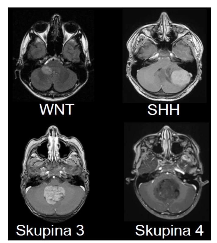 Zobrazení MRI charakteristik jednotlivých podskupin meduloblastomu.
A – Wnt-aktivovaný meduloblastom s extenzí do mostomozečkového
koutu vpravo a do mozečkového pedunklu. B – SHH – aktivovaný
meduloblastom lokalizovaný v levé mozečkové hemisféře. Takové laterální
uložení je charakteristické pro SHH meduloblastom. C – Skupina 3 – tumor
uložený ve vermis a 4. mozkové komoře s výrazným homogenním sycením
po podání kontrastní látky. D – Skupina 4 – uložený ve vermis a 4. mozkové
komoře s absencí sycení po podání kontrastní látky, což je charakteristika
typická pro meduloblastom Skupiny 4.