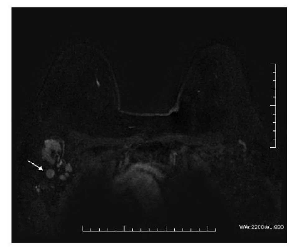 MRI postkontrastní sekvence axiálně, subtrahované
obrazy, vícečetné patologicky zvětšené LU v pravé
axile (označeny šipkou).<br>
Fig. 4: Axial post-contrast MRI sequence, subtraction imaging,
multiple pathologic enlarged lymph nodes in the
right axilla (marked by the arrow).