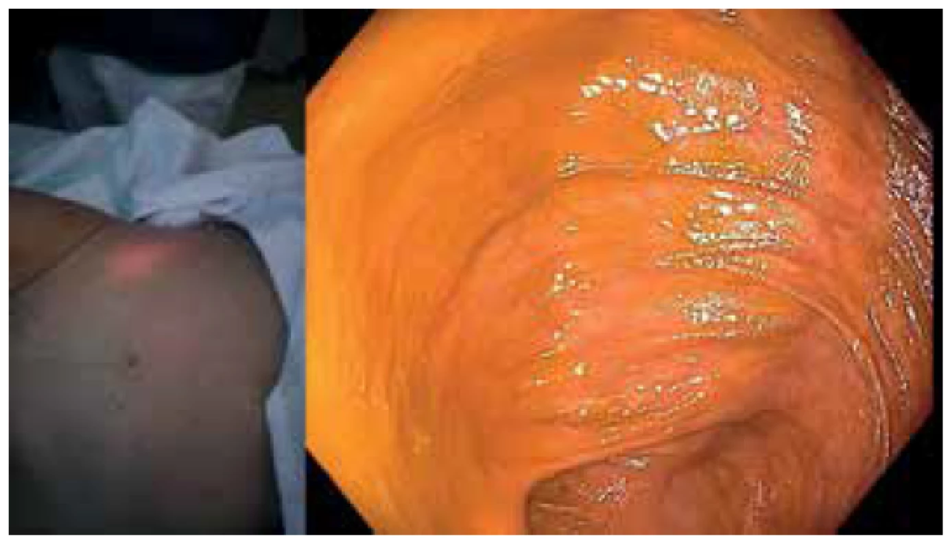 Transiluminace břišní stěny (vlevo); koloskopický
pohled v oblasti céka (vpravo)<br>
Fig. 1. Transillumination of the abdominal wall (left); colonoscopic
view of the cecal area (right)