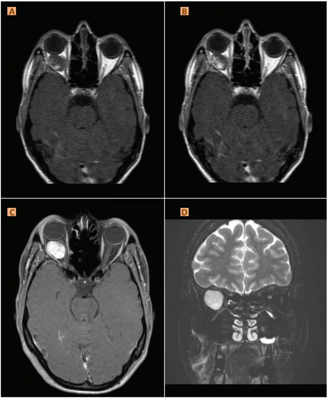 Kavernózní hemangiom: (A, B) postupné dosycování v dynamické studii, (C) nasycený tumor v T1STIR, (D) hypersignální dobře ohraničený intrakonální útvar v T2STIR 