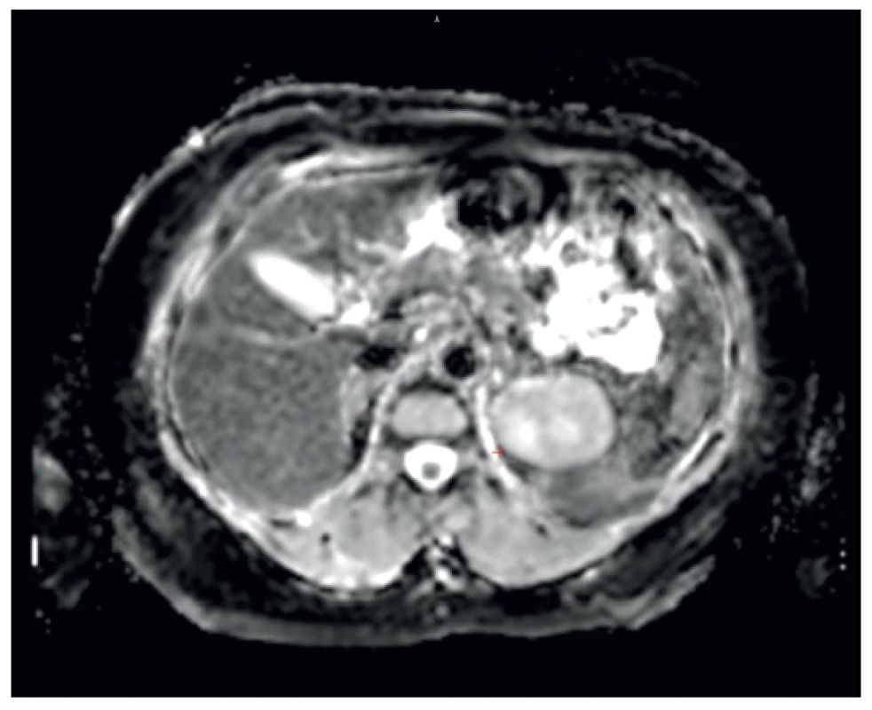 Vyšetření magnetickou rezonancí. V 5. segmentu
jater je subkapsulárně viditelné ložisko velikosti 10x10 mm<br>
Fig. 3. A magnetic resonance imaging. Subcapsular lesion
sized 10x10 mm can be seen in the subcapsular region of
the 5th segment of the liver
