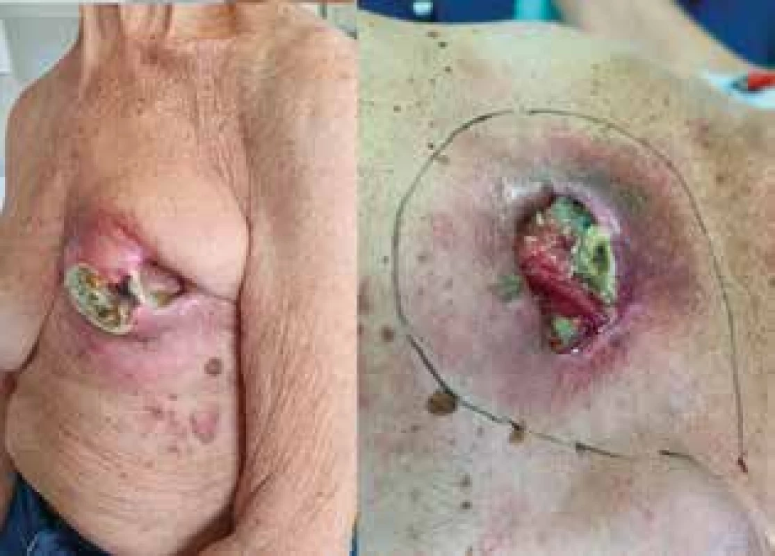 Lokální nález defektu před operací<br>
Fig. 2: Preoperative local finding