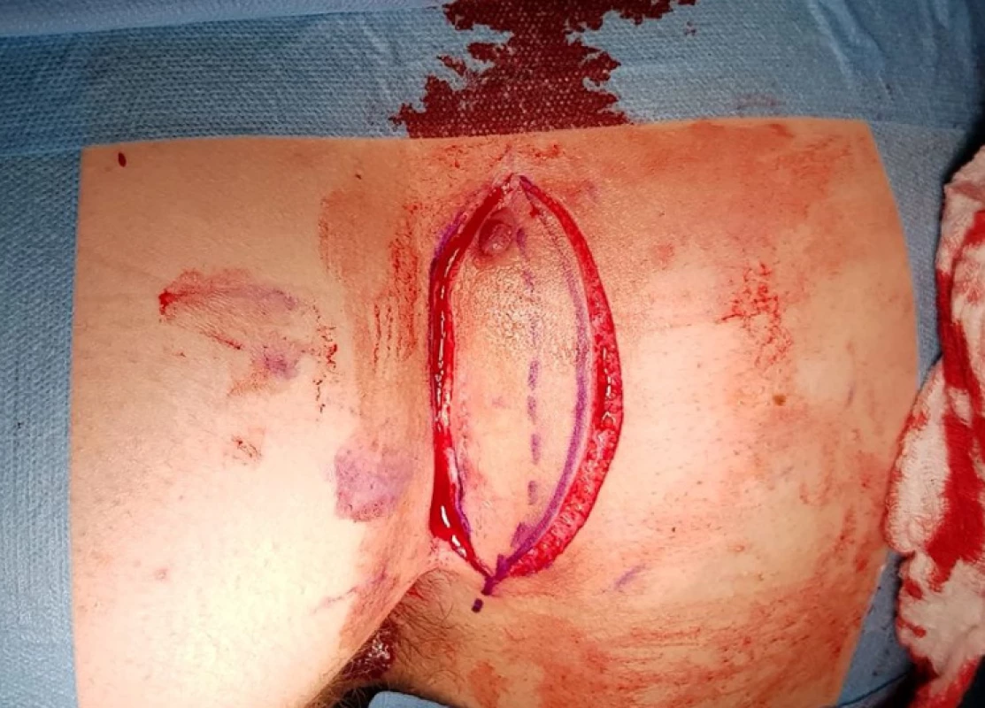 Linie incize<br>
Fig. 1: Incision line