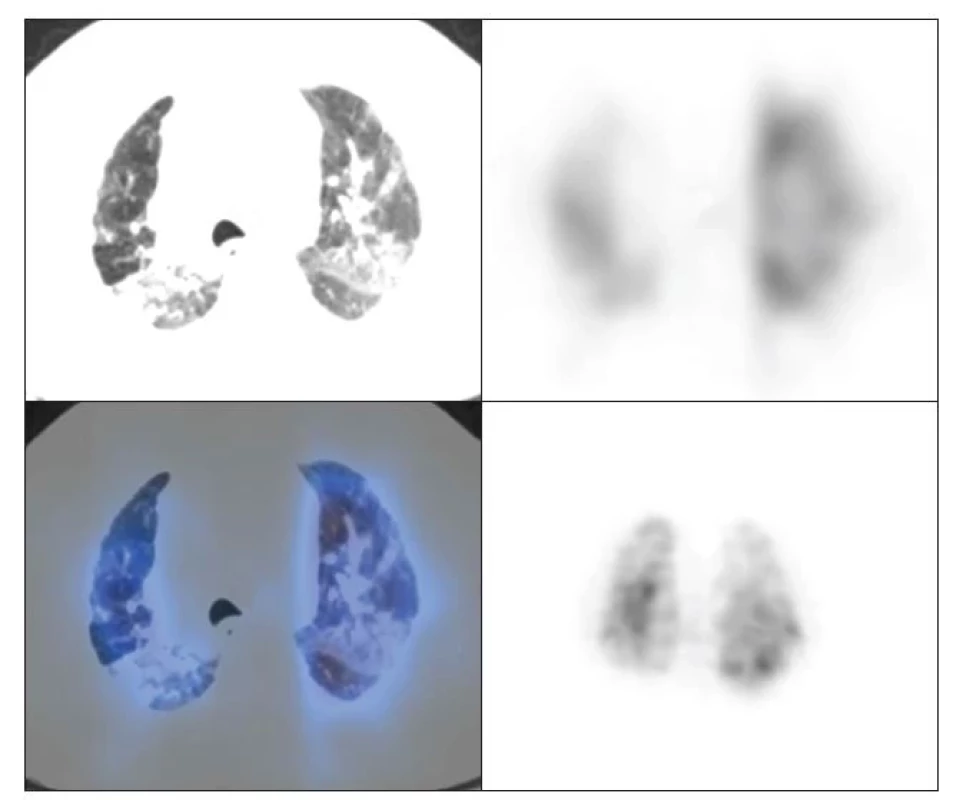 Hybridní zobrazení plic v úrovni bifurkace trachey. Nahoře transversální řezy, vlevo
CT, vpravo SPECT. Vlevo dole fuze obrazů, vpravo dole 3D obraz SPECT.