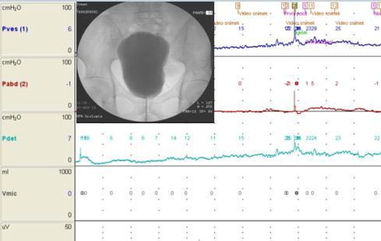 Kontrolní videourodynamické vyšetření
r. 2002 (archiv autora)<br>
Fig. 3. Videourodynamic control 2002