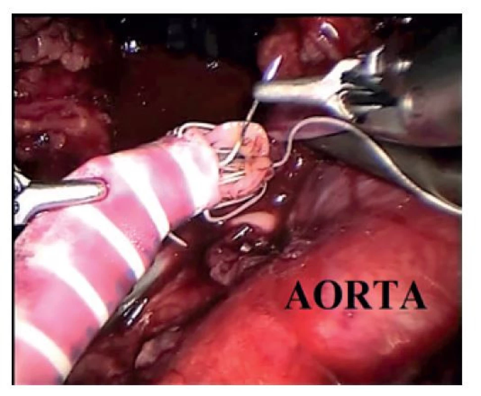 Robotický iliakorenální bypass<br>
Fig. 8: Robotic iliacorenal bypass