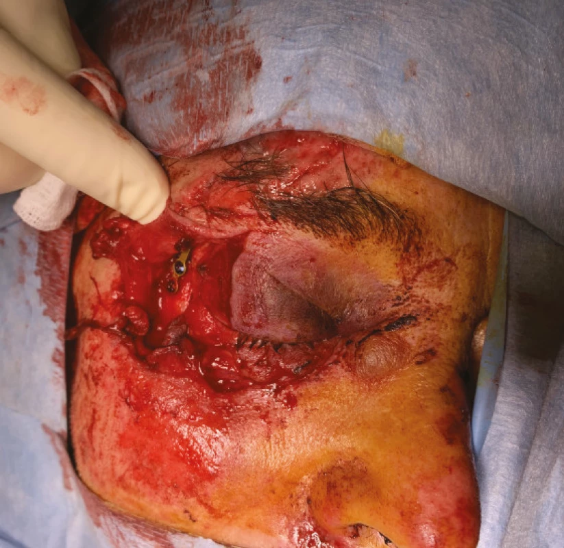 a. Severe injury to orbit and eyelids in traffic accident. Performed reconstruction of the fracture of the outer wall of the
orbit by a stomatosurgeon is visible
