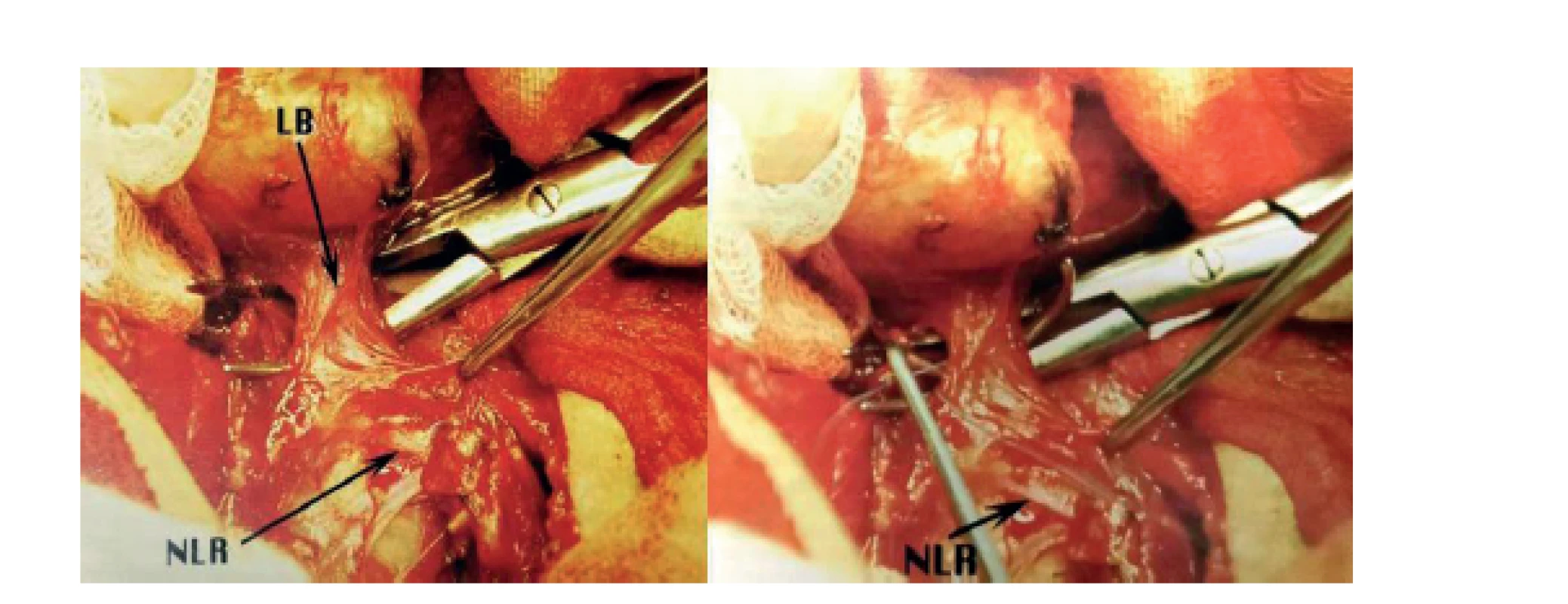 Přerušení LB<br>
Fig. 7: The cutting of LB