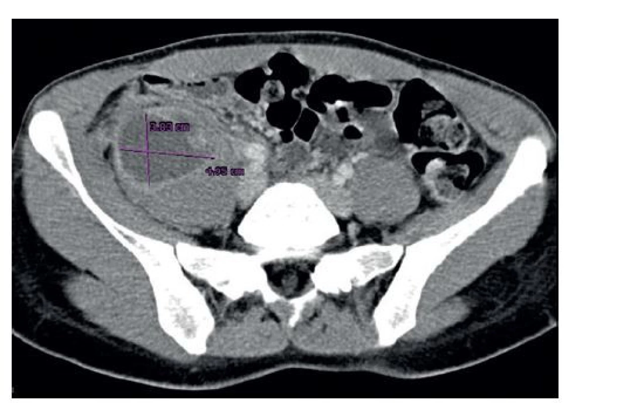 Kontrastné CT vyšetrenie (axiálna projekcia) s nálezom
retroperitoneálneho abscesu vpravo<br>
Fig.1: Contrast CT scan (axial plane) with the finding of
a retroperitoneal abscess on the right