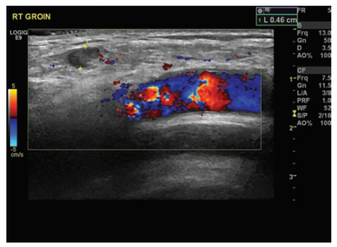 Ultrazvuk pravé kyčle zobrazující cystu a vztah
k velkým cévám<br>
Fig. 3: US right groin showing cyst and its relation to big
vessels