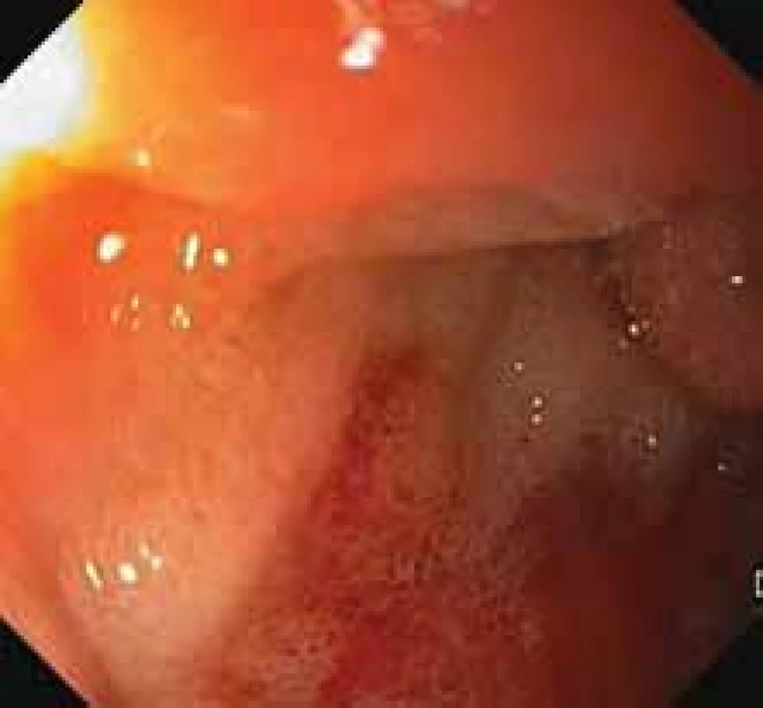 Zánětlivé změny duodenojejunálního přechodu v enteroskopickém
obraze.<br>
Fig. 3. Inflammatory changes of the
duodenojejunal junction in the enteroscopic image.