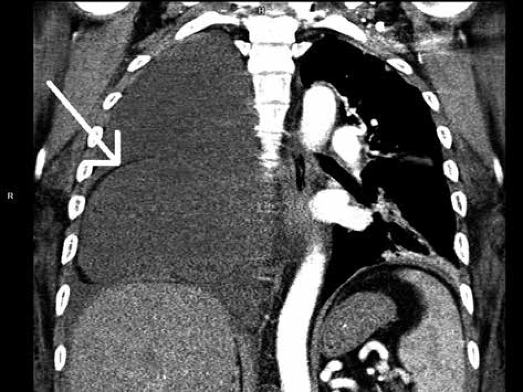 CT hrudníku, kde je patrný kýlní vak vyplněný tekutinou a fluidotorax vpravo<br>
Fig: 3: CT scan of the chest with the hernia sac filled with
fluid and right-sided fluidothorax