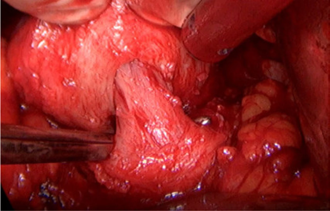 Detail uvolněného hrdla bez použití koagulace<br>
Fig. 2. Detail of dissected bladder neck without using
coagulation