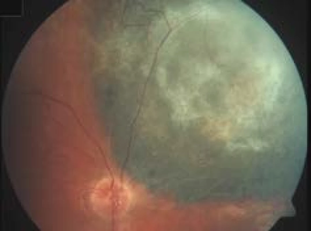 Obliterated blood vessels and fibrous changes in tumour
following proton therapy