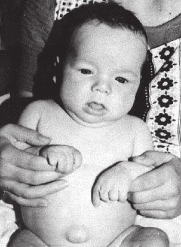 Kojenec s neléčenou vrozenou hypotyreózou v 7 měsících věku (z archivu prof. MUDr. Olgy Hníkové, CSc.).<br>Fig. 3. Untreated case of congenital hypothyroidism at the age of 7 months (provided by prof. MUDr. Olga Hníková, CSc.).