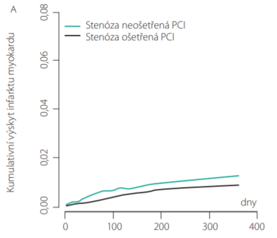 Riziko dalšího infarktu myokardu ve stenózách ošetřených a neošetřených PCI (3)
