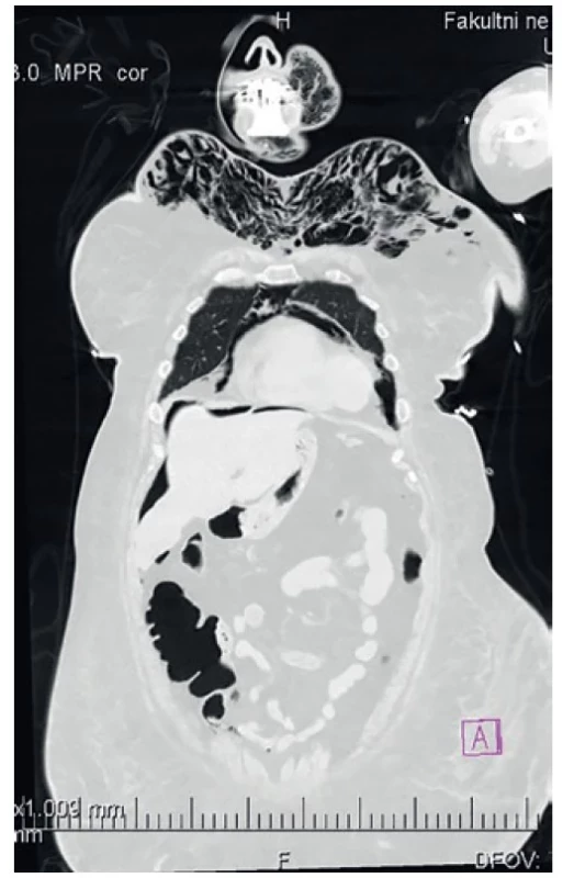 CT nález – pneumoperitoneum, pneumomediastinum,
podkožní emfyzém trupu, krku a obličeje<br>
Fig. 3: CT findings – pneumoperitoneum, pneumomediastinum,
subcutaneous emphysema of the torso, neck and face