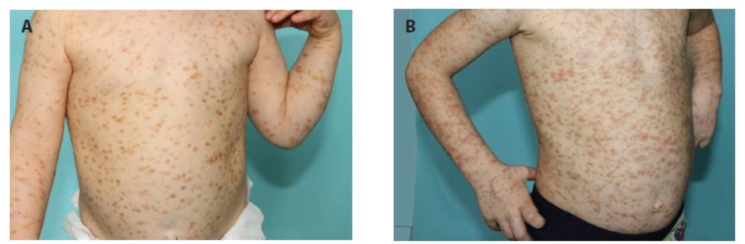 Čtyřletý chlapec s projevy od čtyř měsíců věku<br>
a) projevy na trupu ve 2 letech,<br>
b) ve 4 letech věku<br>
Mediátorové příznaky: v anamnéze 1krát anafylaktický šok po poštípání hmyzem, jiné mediátorové příznaky neudává, tryptáza
24 nm/l, bez organomegalie, pravidelně sledován na dětské kožní ambulanci, vyšetření u hematologa bez suspekce na systémové postižení,
biopsie kostní dřeně neindikována, patrná progrese kožních projevů v průběhu 2 let.
