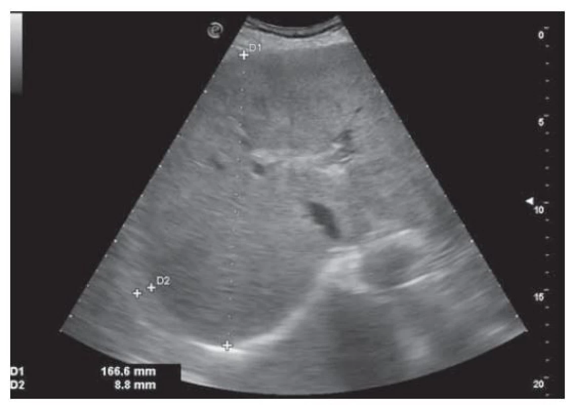 USG nález steatózy heparu s hepatomegáliou
a perihepatálnym ascitom.<br>
Fig. 1. USG finding of liver steatosis with hepatomegaly and
perihepatic ascites.