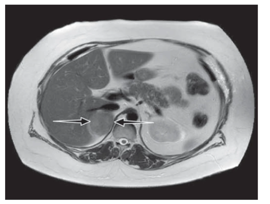 Nativní magnetická rezonance nadledvin: tumor
pravé nadledviny velikosti 55 x 40 x 50 mm s výrazným
lehce nehomogenním poklesem signálu out-of-phase sekvenci
odpovídající charakteru adenomu.<br>
Fig. 2. Magnetic resonance imaging without contrast showed
a mass on the right side of the adrenal gland (size
55 x 40 x 50 mm) with a lower signal indicating the characteristics
of the adenoma.