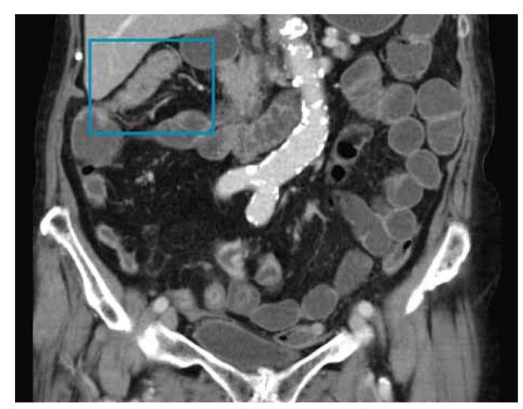 MR enterografie s nálezem zánětlivých změn pravého tračníku
(v modrém rámečku).<br>
Fig.1. MR enterography with inflammatory changes of the right colon
(in the blue box).
