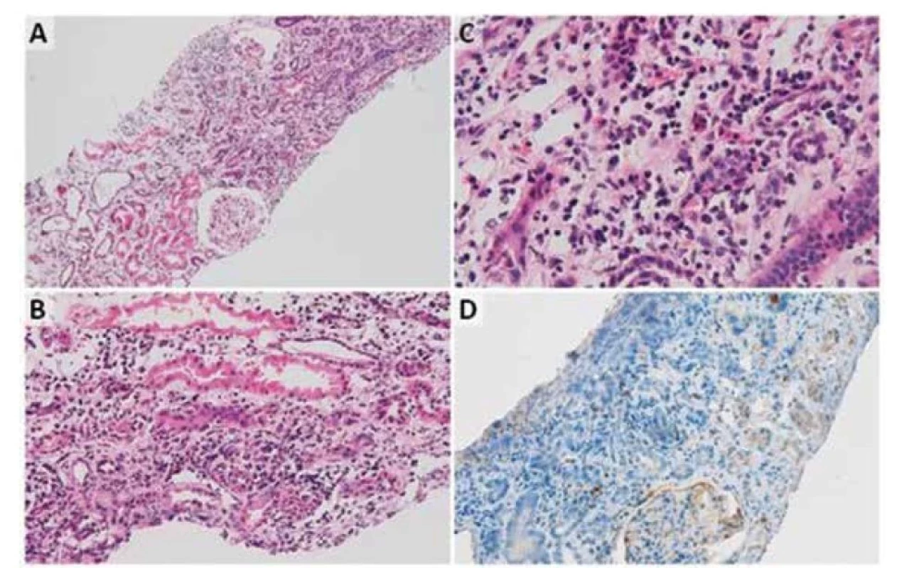Punkční biopsie ledviny naší pacientky. Histologický obraz se zcela intaktními glomeruly bez sklerotizace
či srpků. (A, hematoxylin-eosin, zvětšení 40x), s edémem a zánětem interstitia a samotných tubulů,
místy až s jejich rozpadem (B, hematoxylin-eosin, zvětšení 200x). Zánětlivý infiltrát je s převahou lymfocytů,
fokálně jsou zastoupeny nečetné eosinofilní a neutrofilní granulocyty (C, hematoxylin-eosin, zvětšení 400x).
V imunohistochemickém vyšetření pro IgG byly pozitivní jenom ojedinělé plazmatické buňky (D, hematoxylin
a DAB, zvětšení 100x)