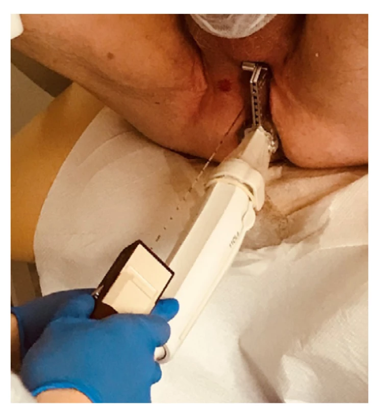 Transperineální biopsie prostaty pomocí freehand
techniky s vertikálním navigačním nástavcem
(archiv autora)<br>
Fig. 5. Transperineal prostate biopsy using the freehand
technique and a vertical needle guide (author’s
archive)
