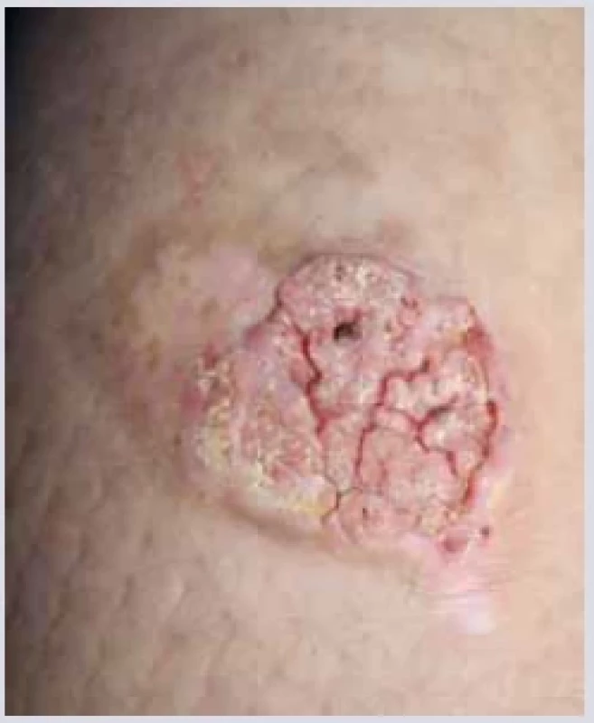 Intraepiteliální dlaždicový
karcinom. <br> 
Fig. 6. Intraepithelial squamous cell
carcinoma.