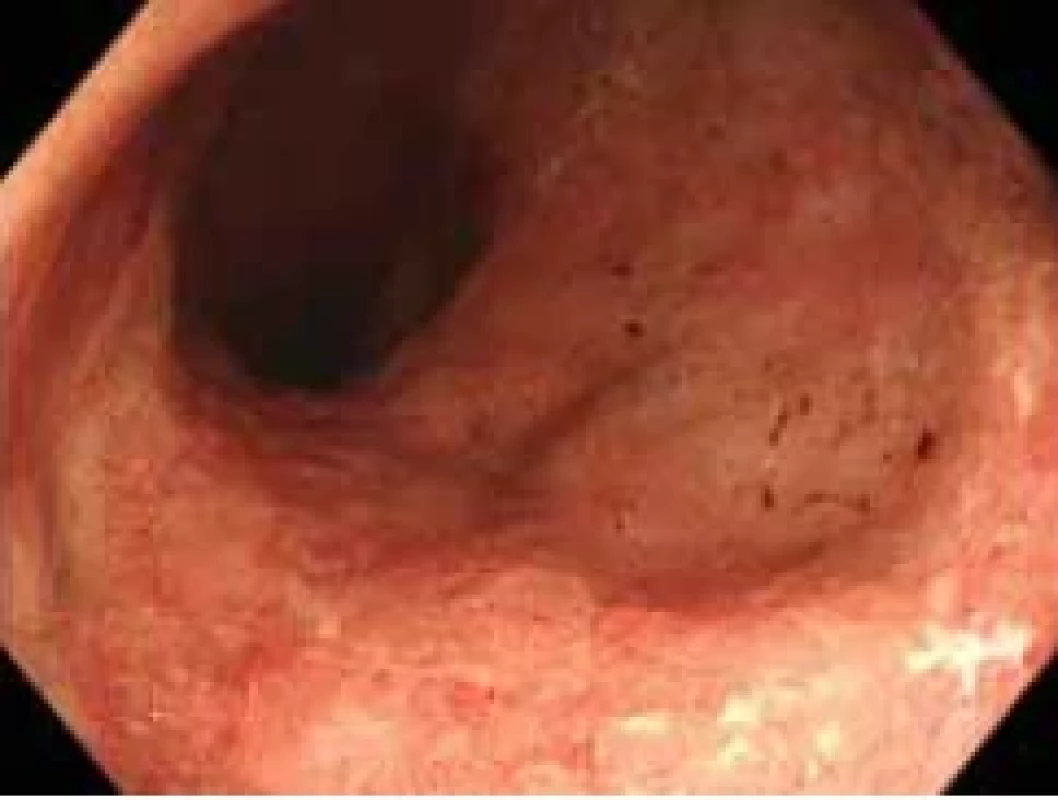 Ampula rekta s obrazem chybějící cévní kresby, erytému sliznice s hlenovitým povlakem a kontaktní krvácivostí.</br>Fig. 1. Ampulla of the rectum with an image of missing vascular pattern, mucous membrane erythema and contact bleeding.