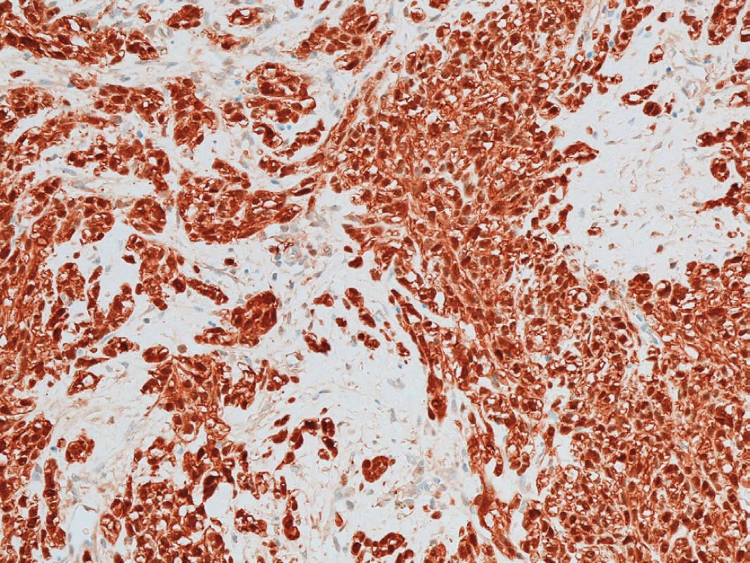 Difuzní exprese S-100 proteinu<br>
Fig. 2: Diffused expression of S-100 protein