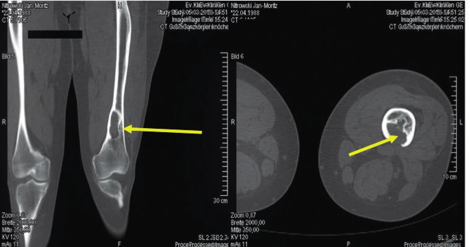Osteolytické ložisko ve femoru narušující kortikalis<br>
Snímek zapůjčil pro tuto publikaci prof. Claus Doberaurer
z Gelsenkirchenu, Německo.