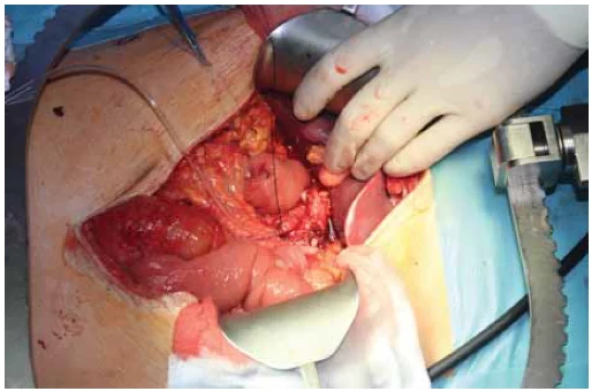 Inzercia kanyly do pahýľa véna lienalis. <br> 
Fig. 5. Insertion of a catheter into rest of vena lienalis.