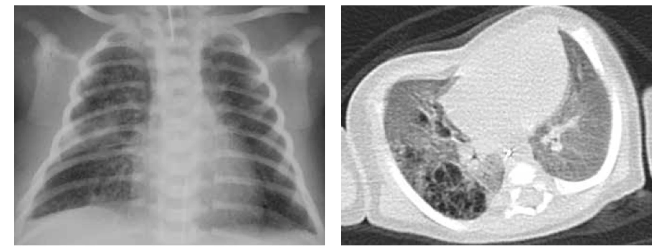 A. RTG plic, CPAM pravé plíce prenatálně diagnostikovaná, známky RDS.<br>
Fig. 3A. Chest X-ray, CPAM in the right lung, diagnosed prenatally, features of RDS.<br>
Obr. 3B. CT hrudníku, transverzální řez, difuzní postižení pravé plíce při CPAM typu 2 v.s.<br>
Fig. 3B. Chest CT scan, transversal cut, diffuse involvement of the right lung by CPAM type 2.