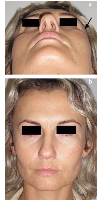 a, b. Patient with visible bulging of the cheek region on the
left (arrow).