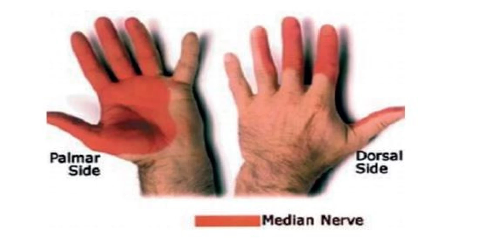 Porucha čití při lézi n. medianus
