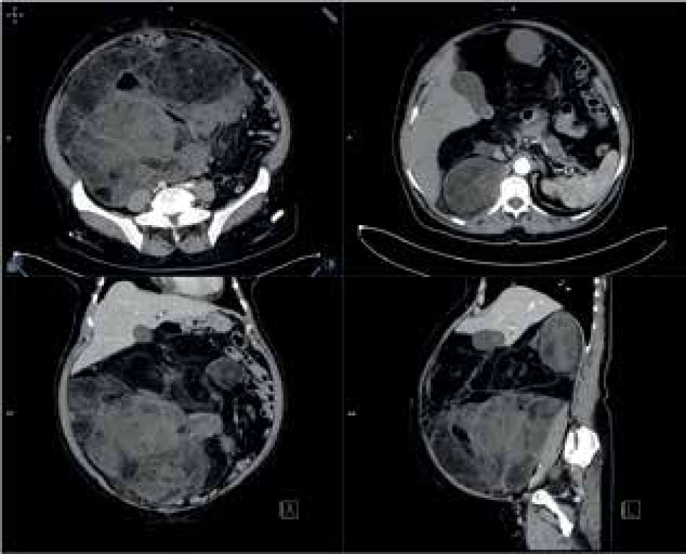 CTA obraz tumoru <br>
Fig. 10: CTA scan of the tumor