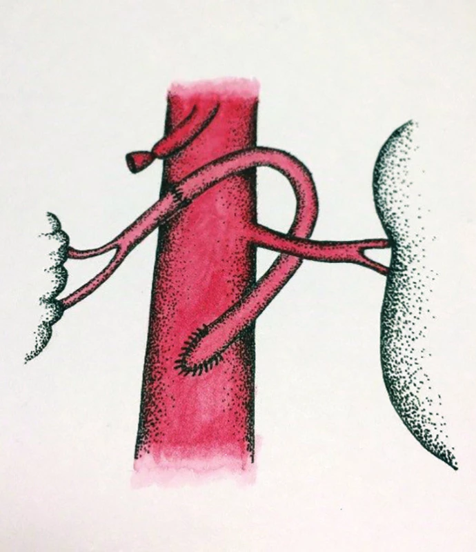 „French“ bypass na AMS (schéma
MUDr. Táňa Baráková)<br>
Fig. 8: “French” bypass on the superior
mesenteric artery
