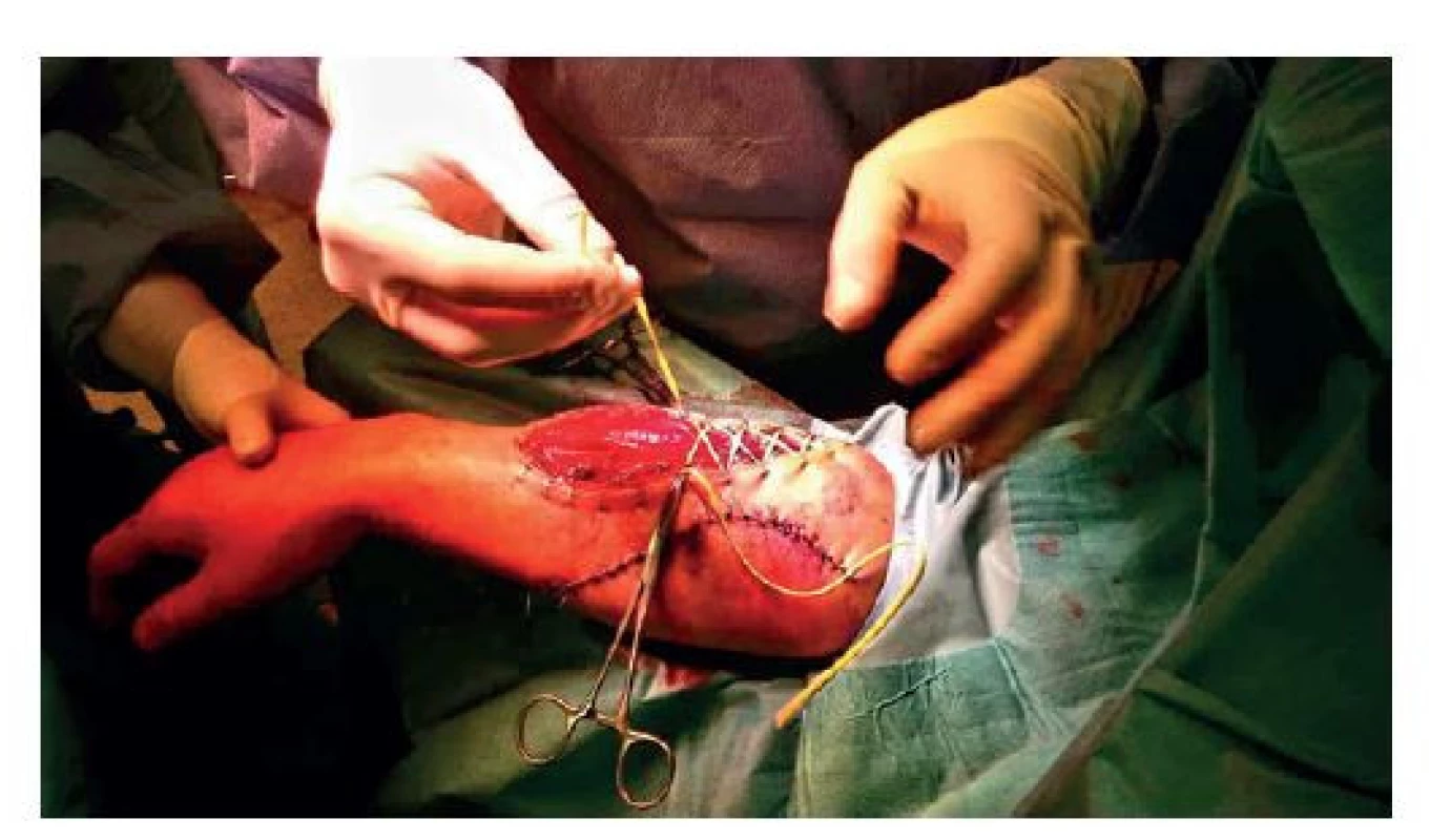 Zakládání elastické ligatury dorzální rány LHK,
částečně zachycena kompletní sutura rány ventrálního
kompartmentu<br>
Fig. 4: Elastic ligature of the dorsal wound on the left
upper limb; partial view of complete suture of the ventral
compartment