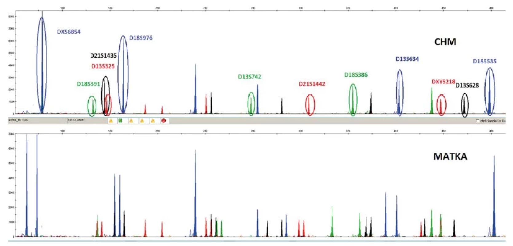 Průkaz CHM vzniklé kompletní endoreduplikací chromozomální sady jedné spermie. Analyzováno kitem SuperSTAR Optima (CE marked IVD kit, Cyber-
Gene AB, Sweden). Karyotyp odpovídá 46, XX, ale všechny chromozomy jsou od otce a v páru shodné. Porovnání profilu plodu a kontrolního materiálu matky:
jednu kopii by plod vždy dědil od matky – u zakroužkovaných markerů je ale patrné, že nemohou pocházet od matky (není u ní stejně dlouhý ekvivalent markeru).
Rovněž všechny markery mají jen jednu délku STM markeru, což u takového množsví markerů v normální tkáni nenalezneme.