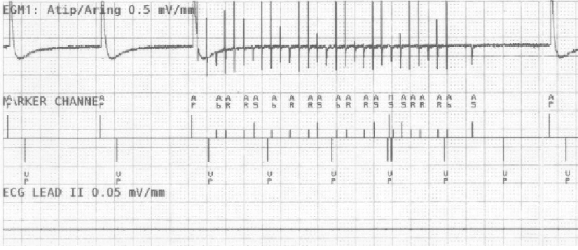 The recording of near-field channel of bipolar
atrial lead during EMI simulation detected as atrial
fibrillation. N.B.: Marker AP = Atrial Pace, AR/AB =
Atrial Refractory/Blanking, VP = Ventricular Pace,
MS = Mode Switching.