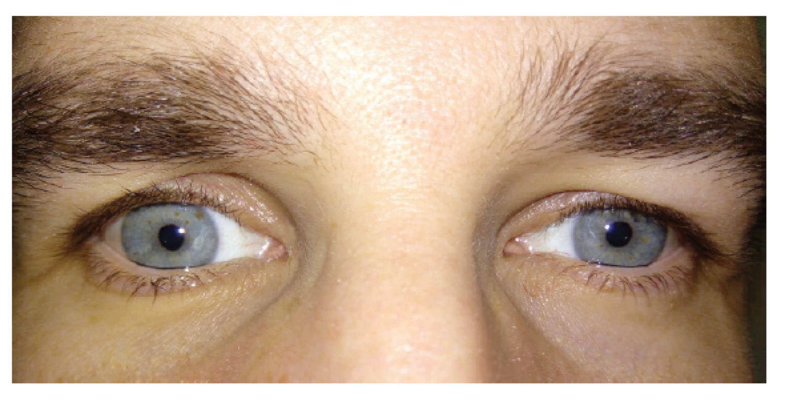 Symmetry of the upper eyelids of both eyes 1 year after
antrostomy