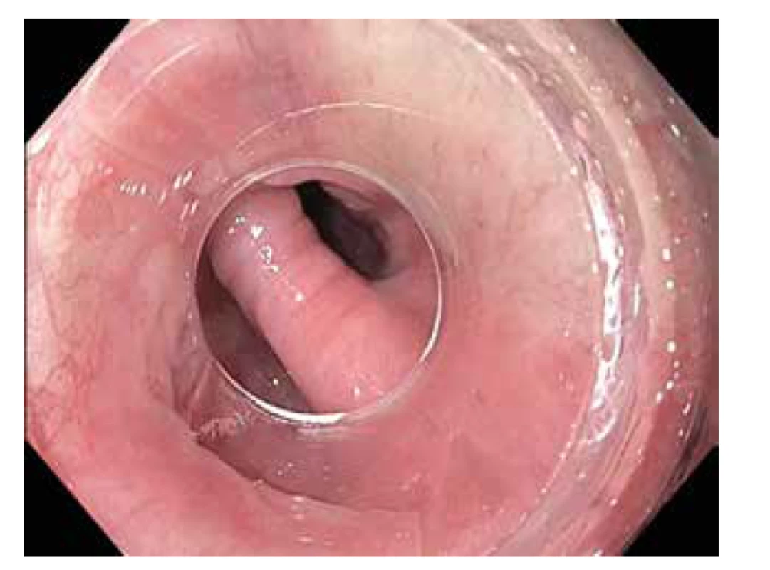 Zenkerův divertikl – endoskopický obraz<br>
Fig. 1: Zenker´s diverticulum – endoscopic view